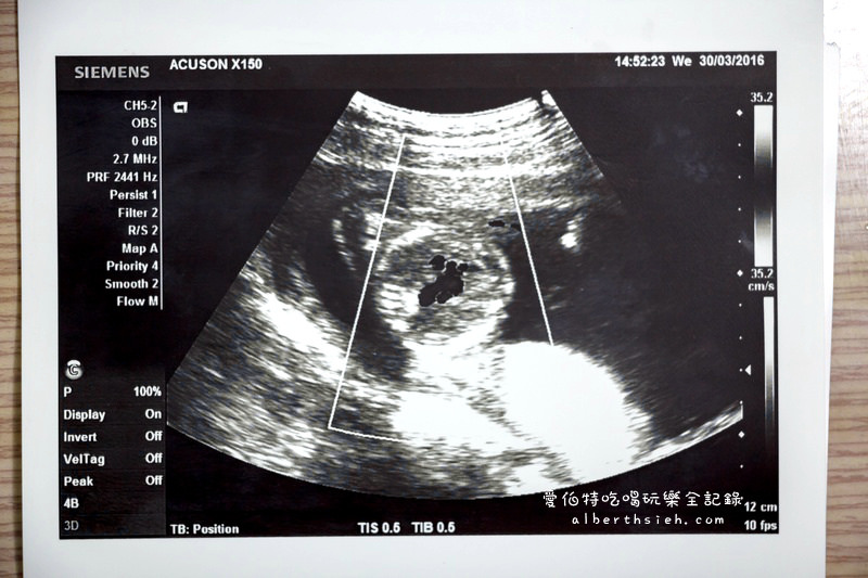 寶寶超音波照片